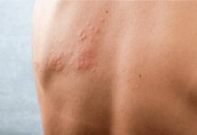 Vaccini: 1 over 50 su 2 con cronicità non parla col medico di Herpes Zoster