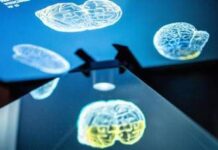 Ictus, ecco come l’emisfero sano del cervello influenza la ripresa: la ricerca rivoluzionaria