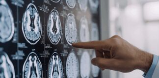 Parkinson, ansia e depressione possono essere segnali precoci: lo studio