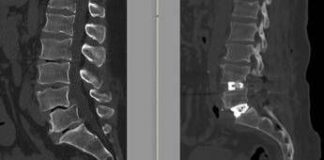 Chirurgia vertebrale complessa, al Tiberia Hospital di Roma intervento con tecnica Alif