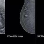 Mammografia ‘intelligente’ al San Camillo di Roma, aiuterà gli specialisti nelle diagnosi