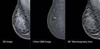 Mammografia ‘intelligente’ al San Camillo di Roma, aiuterà gli specialisti nelle diagnosi