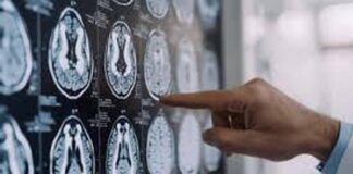 Stop tremori Parkinson senza bisturi, 10 pazienti curati con ultrasuoni a Napoli