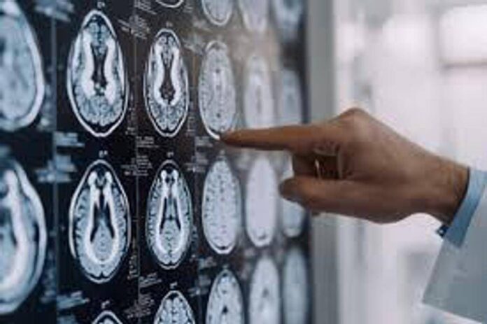 Stop tremori Parkinson senza bisturi, 10 pazienti curati con ultrasuoni a Napoli