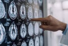 Malattia di Parkinson, ok in Europa a formulazione orale Ld/Cd a rilascio modificato