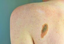 Melanoma, Adoi: “Bene nuova legge su prevenzione, dermatologo centrale in screening”