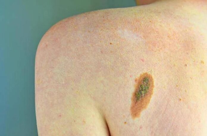 Melanoma, Adoi: “Bene nuova legge su prevenzione, dermatologo centrale in screening”