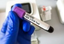 Tumore gastroesofageo Her2+, risultati positivi per tislelizumab con zanidatamab e chemio