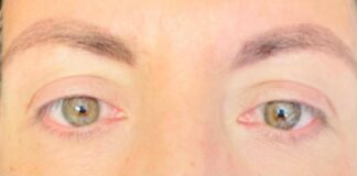 Visione annebbiata o distorta spia di retinopatia. “Ne soffre il 30% dei diabetici, prevenzione l’arma più efficace”