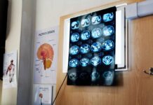 Di Battista, cosa indica un mal di testa forte e improvviso: le ipotesi del neurologo