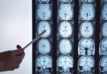 Di Battista e il tumore al cervello, in Italia circa 6mila diagnosi ogni anno: quali sono i sintomi ‘spia’