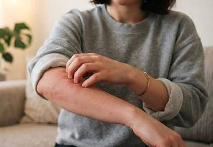 Malattia della pioggia, perché se ne parla: cos’è e sintomi