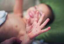 Morbillo, aumentano casi e ricoveri. Bassetti: “In Liguria focolaio senza precedenti, l’Italia rischia gravissima epidemia”