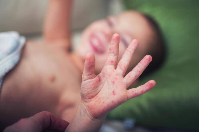 Morbillo, aumentano casi e ricoveri. Bassetti: “In Liguria focolaio senza precedenti, l’Italia rischia gravissima epidemia”