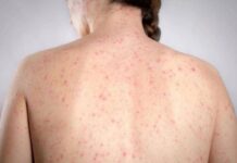Morbillo, l’allarme dell’infettivologo Andreoni: “Casi in crescita, ricoveri frequenti negli adulti”