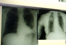 Cancro polmone, con nuova combinazione malattia sotto controllo più a lungo