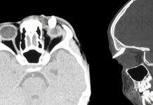 Ha un gonfiore sotto l’occhio, in ospedale scoprono che ha un dente nella palpebra: lo strano caso in India