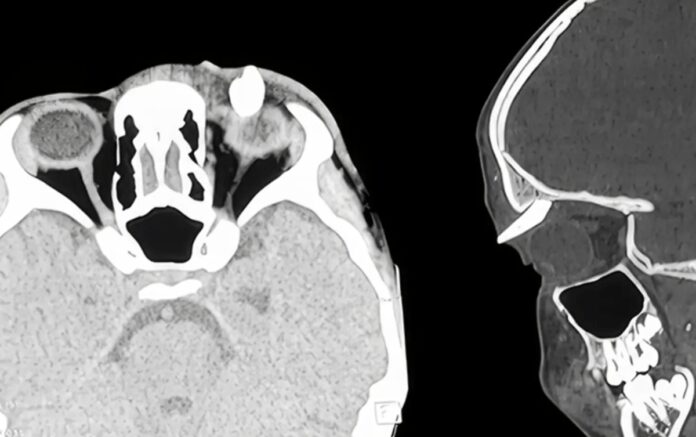 Ha un gonfiore sotto l’occhio, in ospedale scoprono che ha un dente nella palpebra: lo strano caso in India