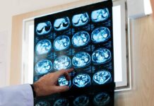 Nodulo polmonare: che cos’è, come si diagnostica e quando intervenire