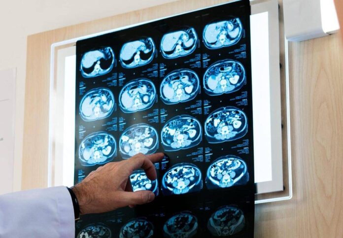 Nodulo polmonare: che cos’è, come si diagnostica e quando intervenire